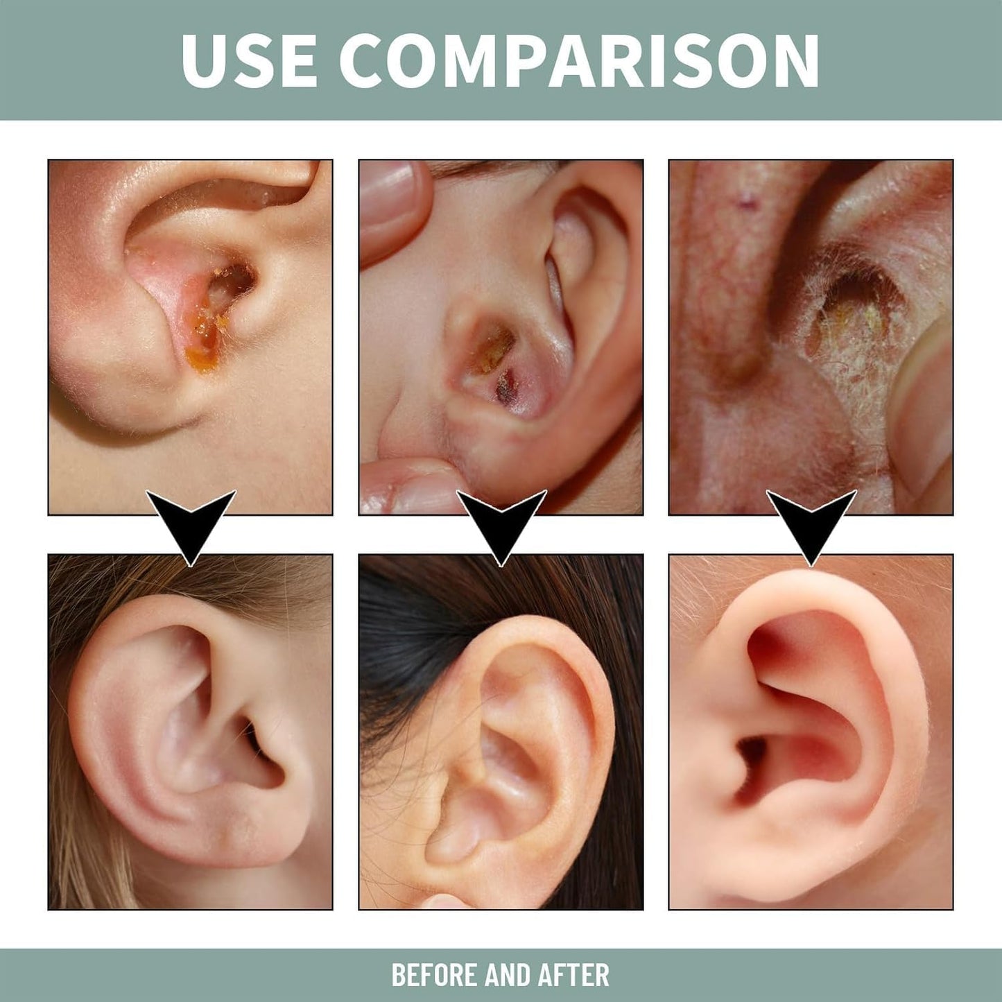 ESPRAY PARA ALIVIAR EL TINNITUS