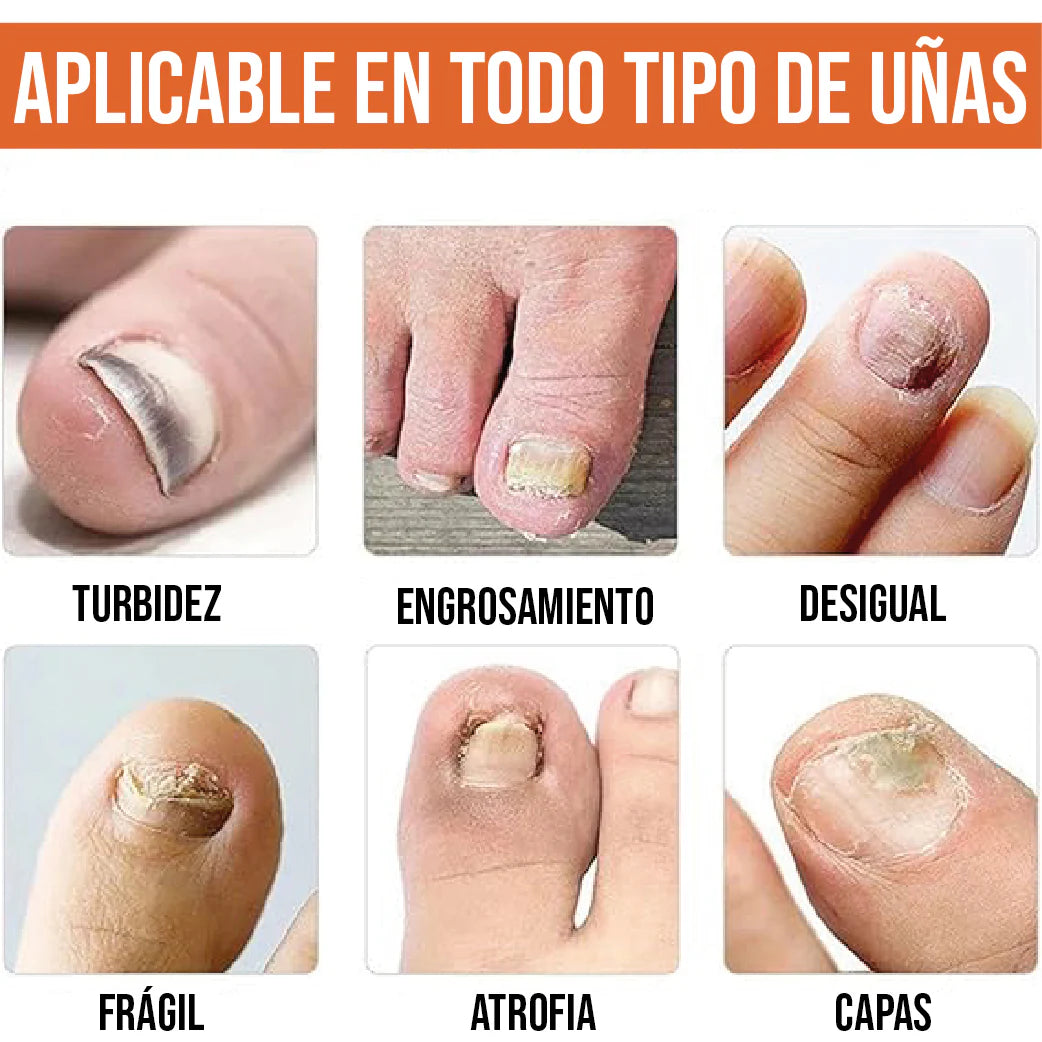 GOTERO PARA HONGOS EN LAS UÑAS